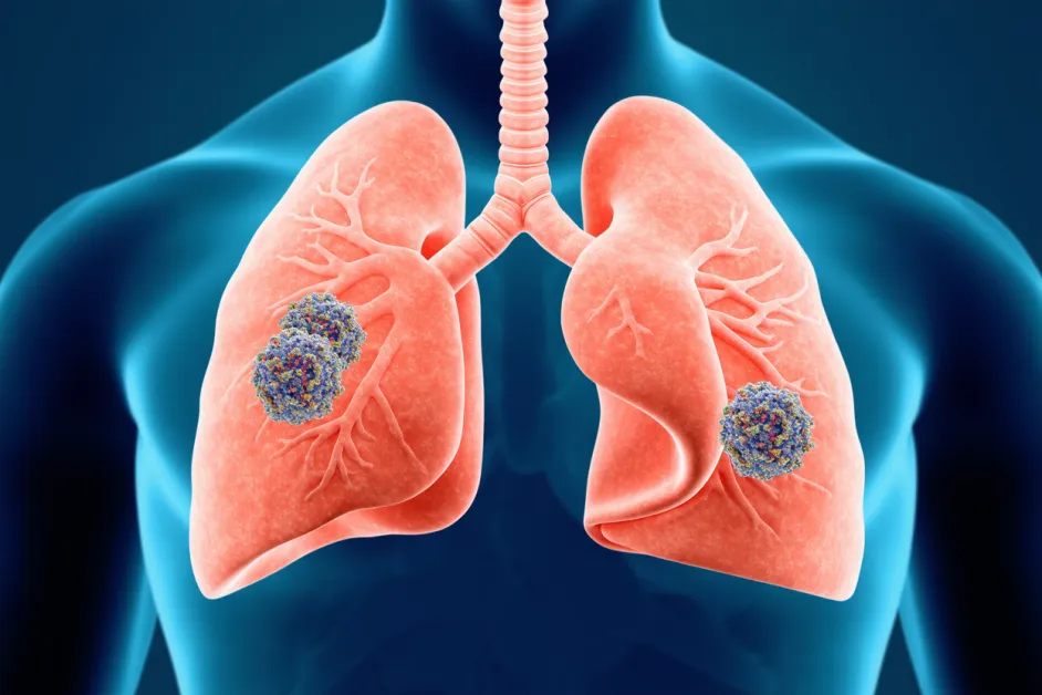 เหตุผลที่ประกันมะเร็งปอดเป็นสิ่งสำคัญสำหรับทุกคน คุ้มครองและลดความเสี่ยงด้านสุขภาพ ป่วยเป็นมะเร็งปอด