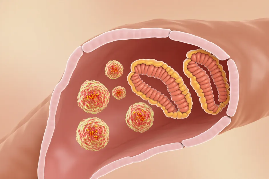 ตัวเลือกประกันที่เหมาะสมสำหรับความคุ้มครองโรคมะเร็งลำไส้ใหญ่ คำถามพบบ่อยประกันมะเร็งลำไส้ใหญ่