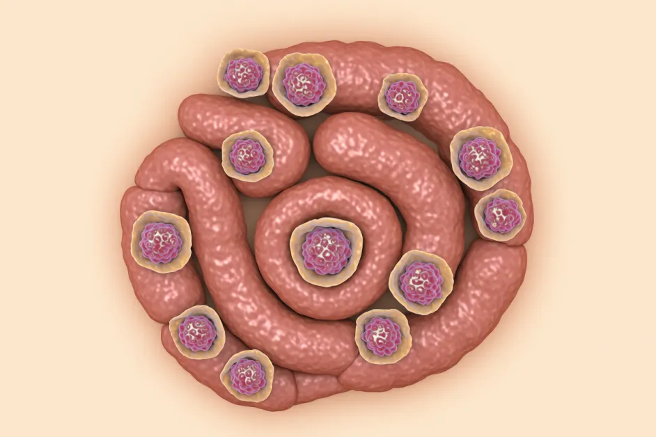 ข้อดีระยะยาวของการทำประกันมะเร็งลำไส้ใหญ่เพื่อการป้องกันสุขภาพในอนาคต